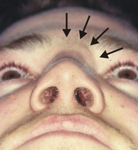 костная мозоль на носу после травмы thumbnail