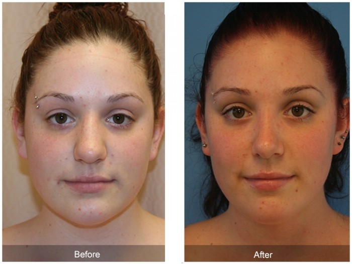 Ринопластика лица до и после фото