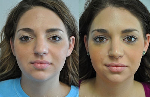 Ринопластика фото до и после нос картошкой ринопластика