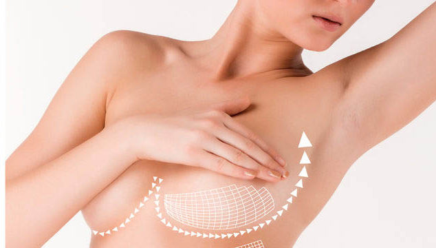 История операций по подтяжке груди
